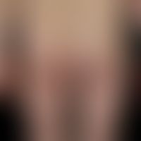Naevus flammeus: angeborener, asymmetrisch angelegter, nicht-syndromaler (keine Gewebehypertrophi...