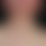 Vaskuläre (kapilläre) Malformation (Naevus flammeus):&nbsp;Kongenitale, generalisierte, symptomlo...