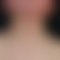 Vaskuläre (kapilläre) Malformation (Naevus flammeus):&nbsp;Kongenitale, generalisierte, symptomlo...