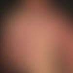 Vascular twin naevus (Naevus&nbsp; vascularis mixtus): Kombination eines Naevus flammeus mit eine...