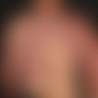 Vascular twin naevus (Naevus&nbsp; vascularis mixtus): Kombination eines Naevus flammeus mit eine...