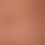 Papules, blue: surprisingly firm surface smooth symptomless papules known for years as a manifest...