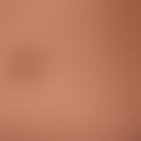 Papules, blue: surprisingly firm surface smooth symptomless papules known for years as a manifest...