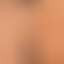 Mucinosis follicularis Typ III: chronische, häufig generalisierte, leicht juckende Verlaufsform b...