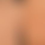 Mucinosis follicularis Typ III: chronische, häufig generalisierte, leicht juckende Verlaufsform b...