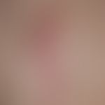 Keloid: diskontinuierliche, wulstige, prominente, livid-rote, über den eigentlichen Narbenbereich...
