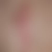 Keloid: diskontinuierliche, wulstige, prominente, livid-rote, über den eigentlichen Narbenbereich...