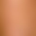 Necrobiosis lipoidica: Necrobiosis lipoidica that has existed for several years. Large, atrophic ...