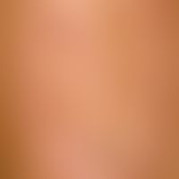 Necrobiosis lipoidica: Necrobiosis lipoidica that has existed for several years. Large, atrophic ...