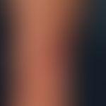 Necrobiosis lipoidica: Necrobiosis lipoidica, which has existed for several years in previously k...