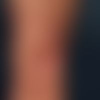 Necrobiosis lipoidica: Necrobiosis lipoidica, which has existed for several years in previously k...
