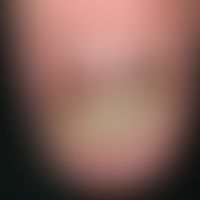 Nagelhämatom: Offenbar durch repetierende Traumata ausgelöste (wahrscheinlich durch ein von front...