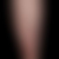 Necrobiosis lipoidica: bilateral, gradually increasing, moderately sharply defined, confluent, re...