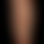 Necrobiosis lipoidica: confluent, reddish-brownish, reddish-brownish, centrally clearly atrophic,...