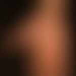 Naevus verrucosus (Detailabbildung) streifenförmige Anordnung von gelb-bräunlichen Papeln und Pla...