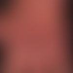 Chronic erythema: Combination of a chronic, laminar erythema with a distinct atrophy of the skin ...