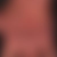 Chronic erythema: Combination of a chronic, laminar erythema with a distinct atrophy of the skin ...