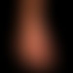 POEMS syndrome: flat, even hyperpigmentation with "scleroderma-like" hardening and swelling of th...
