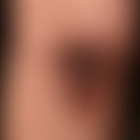 Pemphigus vulgaris:&nbsp;multiple, chronische, seit 3 Jahren schubweise verlaufende, symmetrische...