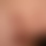 Pemphigus vulgaris. Multiple, chronische, seit 3 Jahren schubweise verlaufende, symmetrische, sta...