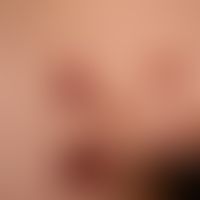 Pemphigus vulgaris. Multiple, chronische, seit 3 Jahren schubweise verlaufende, symmetrische, sta...
