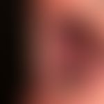 Pemphigus vulgaris: chronisch persistierende, großflächige , schmerzhafte Erosionen an Wangenschl...