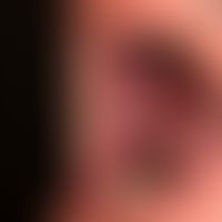 Pemphigus vulgaris: chronisch persistierende, großflächige , schmerzhafte Erosionen an Wangenschl...