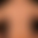 Pemphigus vulgaris: multiple, chronische, seit 3 Jahren schubweise verlaufende, symmetrische, sta...