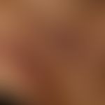 Pemphigus vulgaris. Multiple, chronische, seit 3 Jahren schubweise verlaufende, symmetrische, sta...