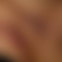 Pemphigus vulgaris. Multiple, chronische, seit 3 Jahren schubweise verlaufende, symmetrische, sta...