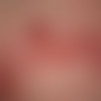 Zoster: in segmentaler Verteilung (Th4), gruppierte Bläschen auf geröteter Haut bei einem 38-jähr...