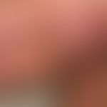 Striae cutis distensae: alte und frische (rote)&nbsp;Striae bei Adipositas permagna und langjähri...