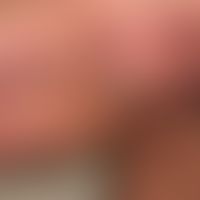 Striae cutis distensae: old and fresh (red) striae in obesity permagna and long-term internal and...