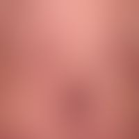 Striae cutis distensae: alte und frische (rote)&nbsp;Striae bei Adipositas permagna und langjähri...