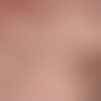 naevus anaemicus: congenital, marginal irregularly dissected, white, smooth spots. no redness aft...