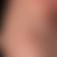 naevus anaemicus: congenital, irregularly dissected white, smooth stains at the edges. no reddeni...
