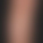 Naevus depigmentosus: congenital harmless localized pigment disorder, no surface progression. cha...