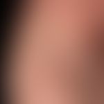Differential diagnosis: Depigmented nevus: Anaemic nevus. Irregularly scattered edges of the stai...