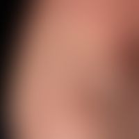 Differential diagnosis: Depigmented nevus: Anaemic nevus. Irregularly scattered edges of the stai...