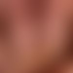 Splinter bleeding: in generalized psoriasis with large oil stains and thickening of the nail plat...