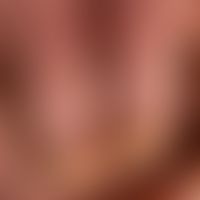 Splitterblutungen: bei generalisierter Psoriasis mit großflächigen Ölflecken und Verdickungen der...