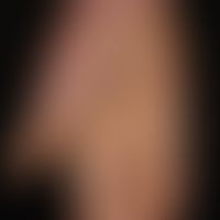 Psoriasis palmaris: trocken-keratotischer Plaque-Typ. Chronische flächige Hyperkeratosen die zu e...