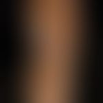 Psoriasis plantaris, dry keratotic plaque type, chronic extensive hyperkeratosis which had led to...