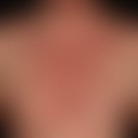 Psoriasis vulgaris chronic active plaque type: long term pre-existing psoriasis, now relapsing ac...