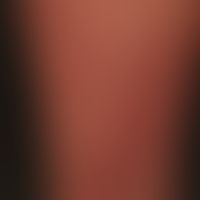 Urticaria pigmentosa (systemische Mastozytose): unterschiedlich große, disseminierte, flache, ova...
