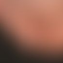 Onycholyse: idiopathische Onycholyse mit nachwachsendem Nagel. Die Zehen 3 und 4 zeigen eine Quer...