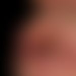 Lip carcinoma: Known since > 1 year, only growing in layers, hard, not shifting, eroded lump, ...