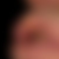 Lip carcinoma: Known since > 1 year, only growing in layers, hard, not shifting, eroded lump, ...