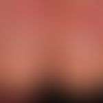 psoriasis of the nails: bilateral nail dystrophy in periungual psoriatic attack of the huat. cuti...