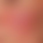 Rosacea erythematosa:&nbsp; flächenhafte und gleichmäßige Rötung beider Wangen. Wechslehafter&nbs...